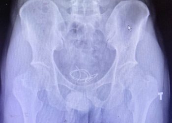 Dây headphone mắc kẹt trong bàng quang nam thanh niên