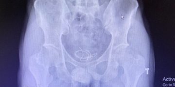 Dây headphone mắc kẹt trong bàng quang nam thanh niên