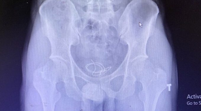 Dây headphone mắc kẹt trong bàng quang nam thanh niên